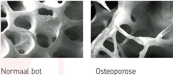 Normaal bot - Osteoporose 