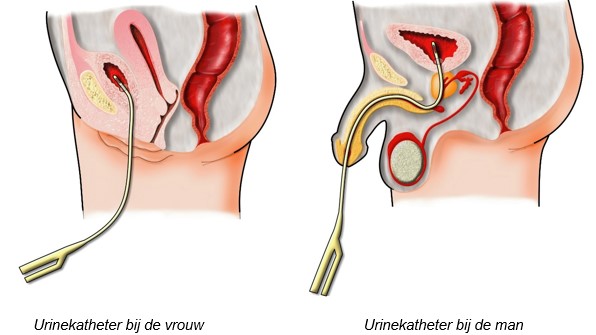 Urine katheter