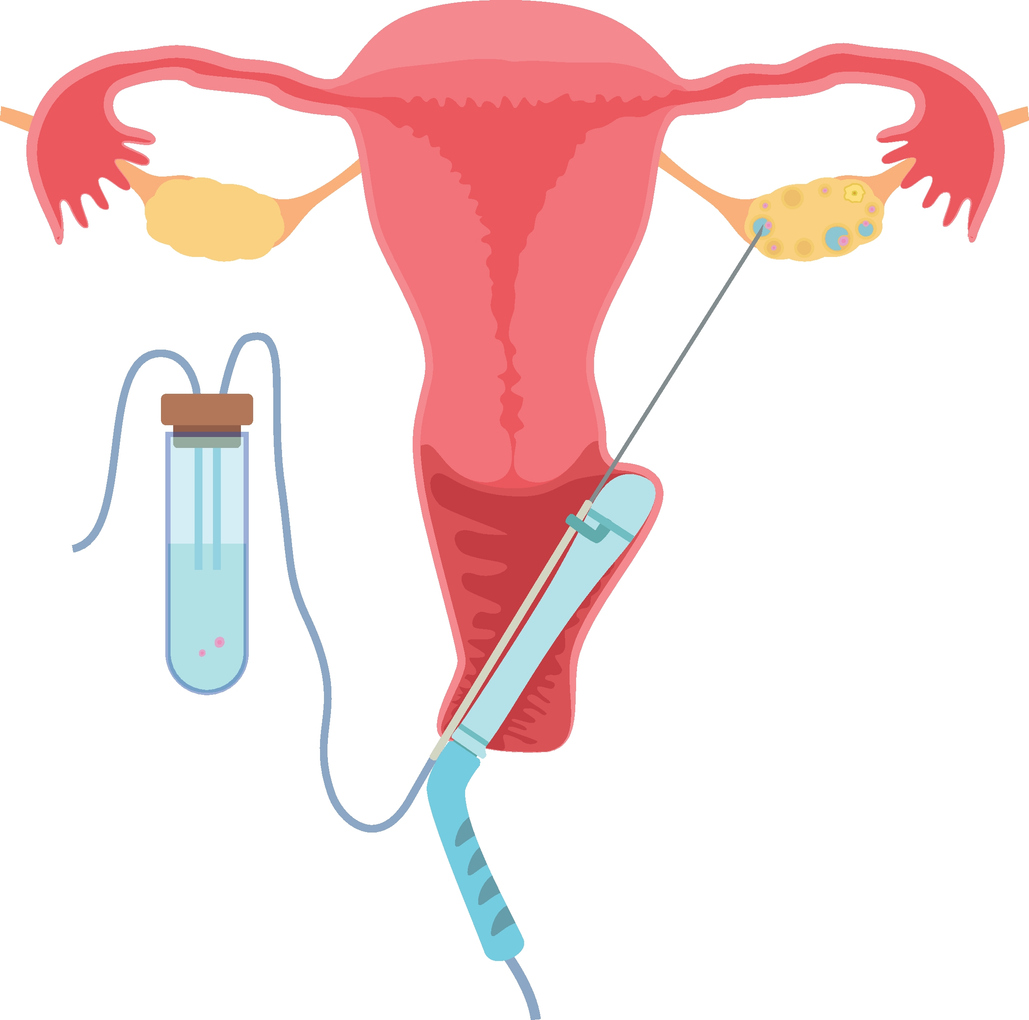 IVF punctie
