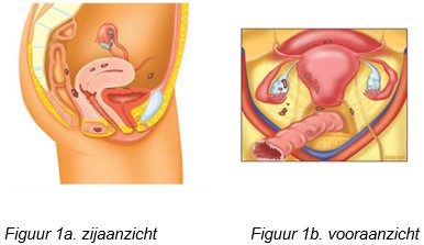 Endometriose fig 1a 1b