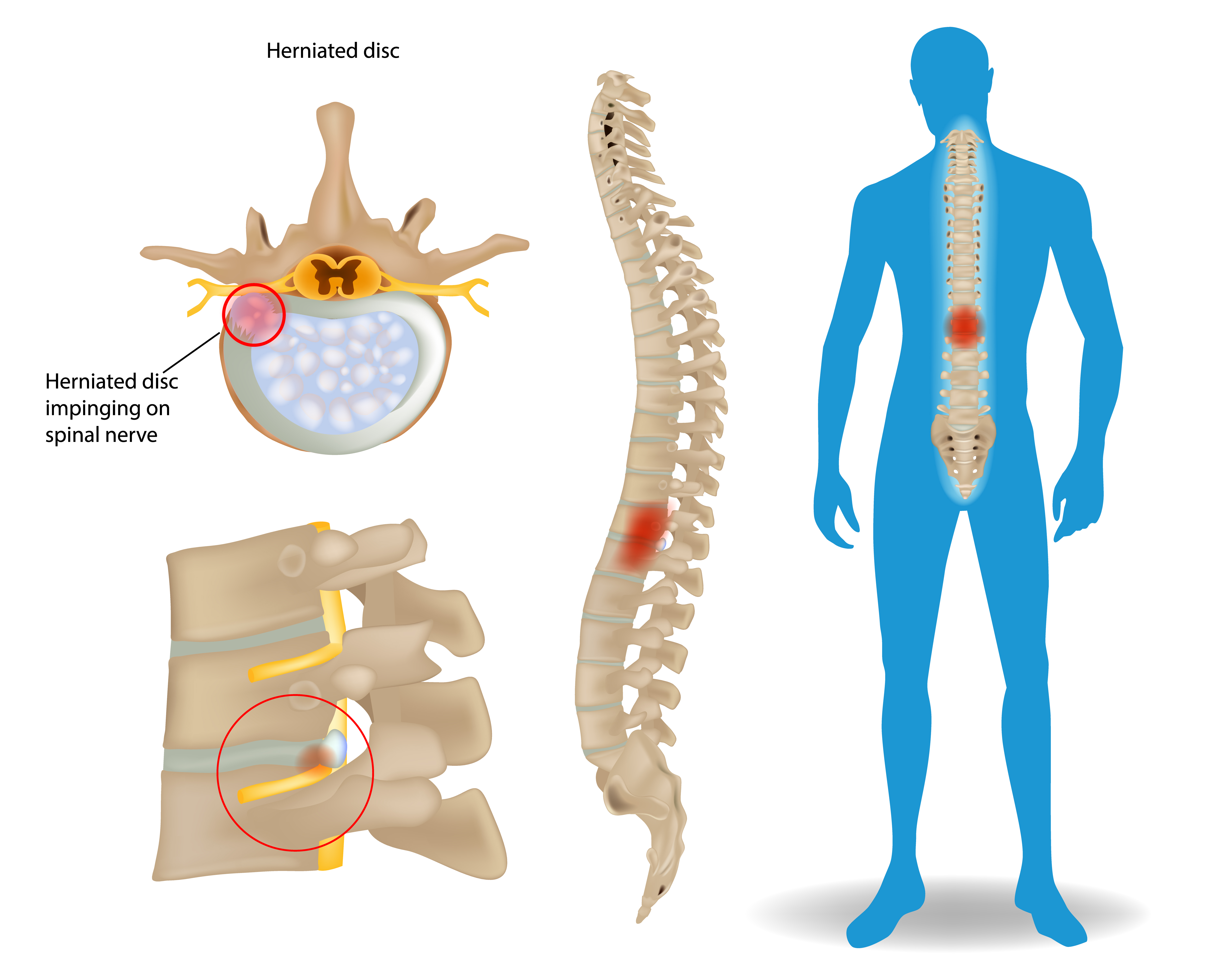 Hernia