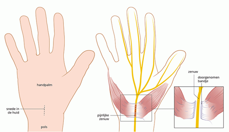 Carpale tunnel syndroom