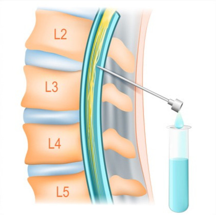 lumbaalpunctie