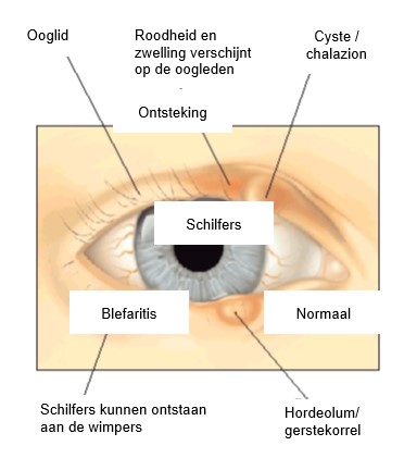 Blefaritis