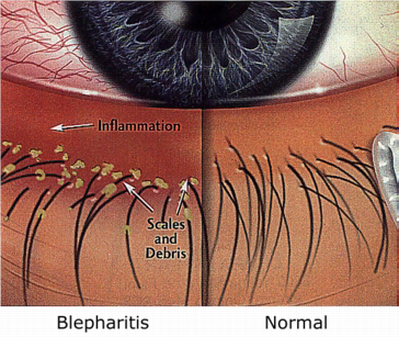 Blepharitis