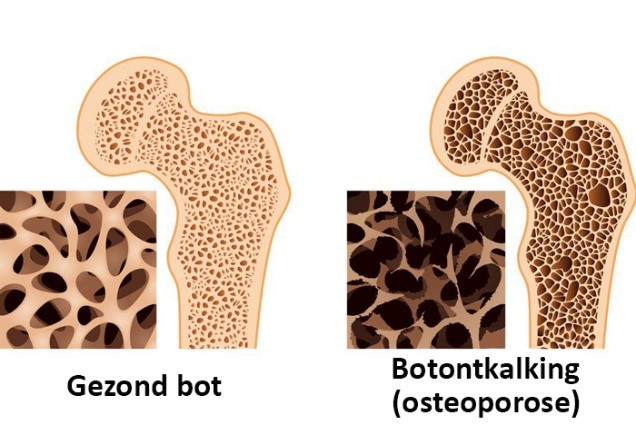 Bisfosfonaten