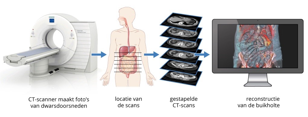 Radiotherapie endeldarmkanker